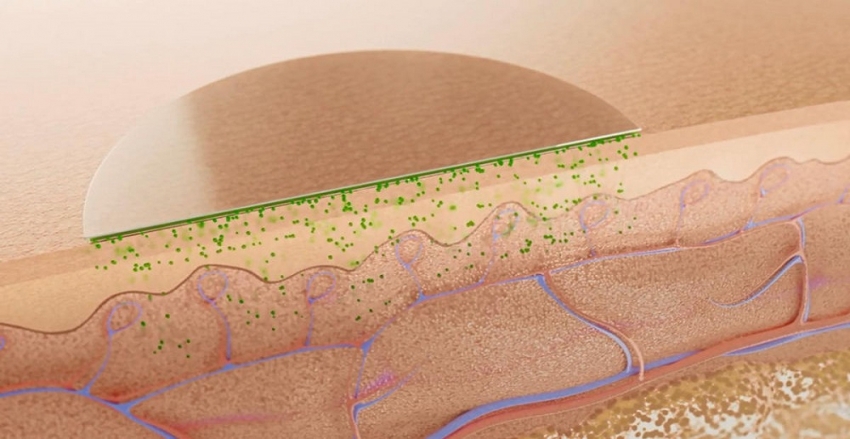 Transtermal Bant Nedir